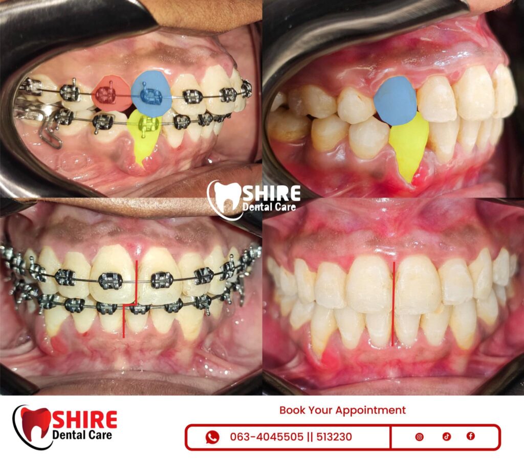 Talooyin Caafimadka qaybta il-kaha